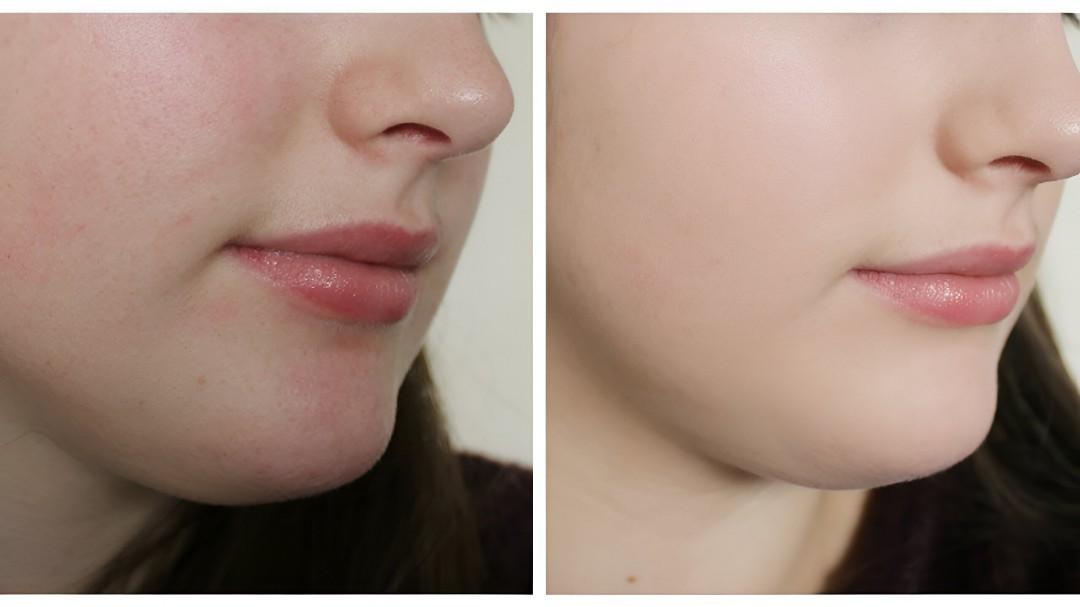 Refined Skin Whitening in Islamabad