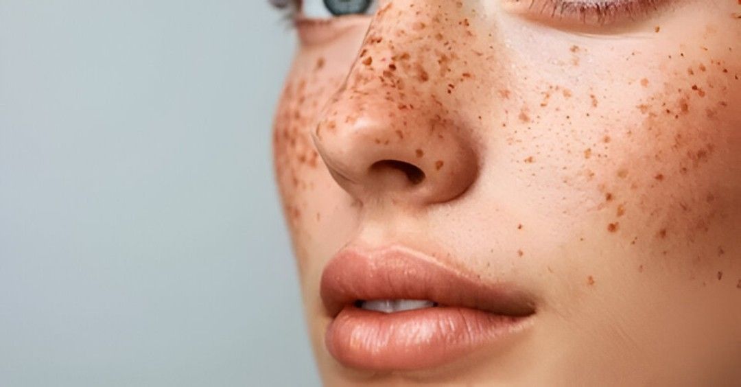 How Serious Is Skin Pigmentation in Islamabad Really?