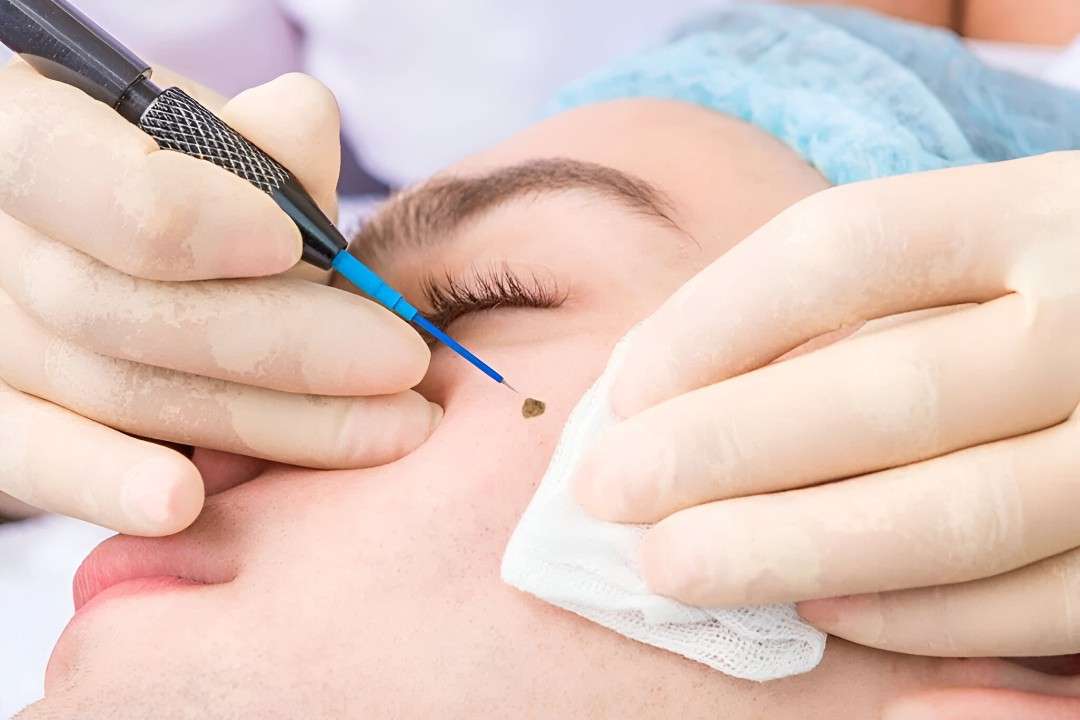 Wart Removal in Islamabad – Regain Your Self-Esteem